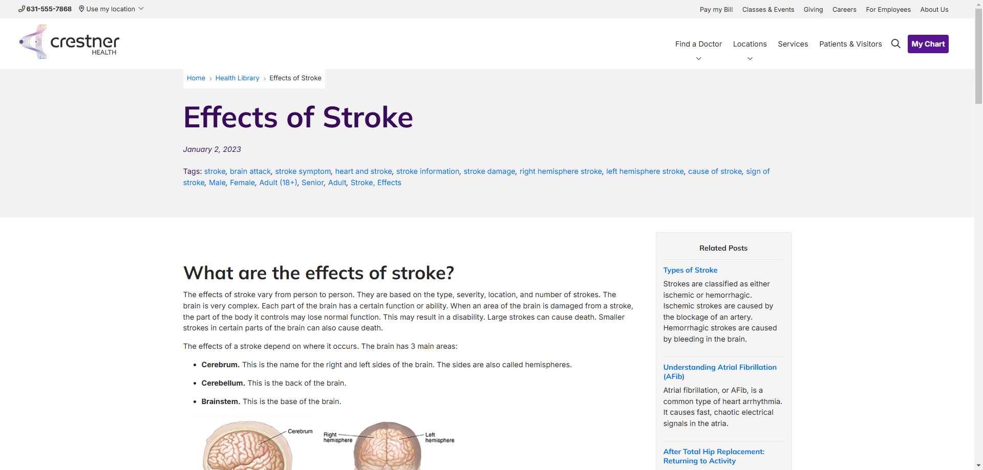 Screenshot of a sample Post page titled 'Effecs of Stroke' showing post tags, an embedded image, and related post links